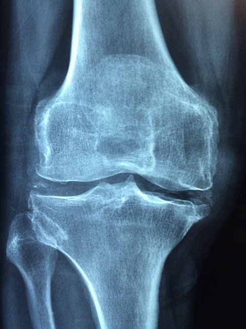 osteoporoza-slika