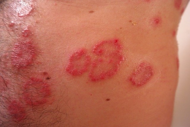 akne rosacea seboroični ekcem izpuščaj