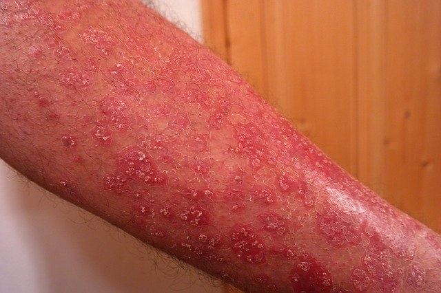 demodex rosacea seboroični dermatitis izpuščaj