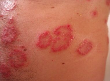 demodex rosacea seboroicni dermatitis seboroični dermatitis
